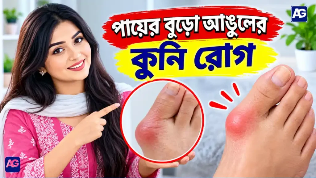 পায়ের বুড়ো আঙ্গুলের কুনি রোগ